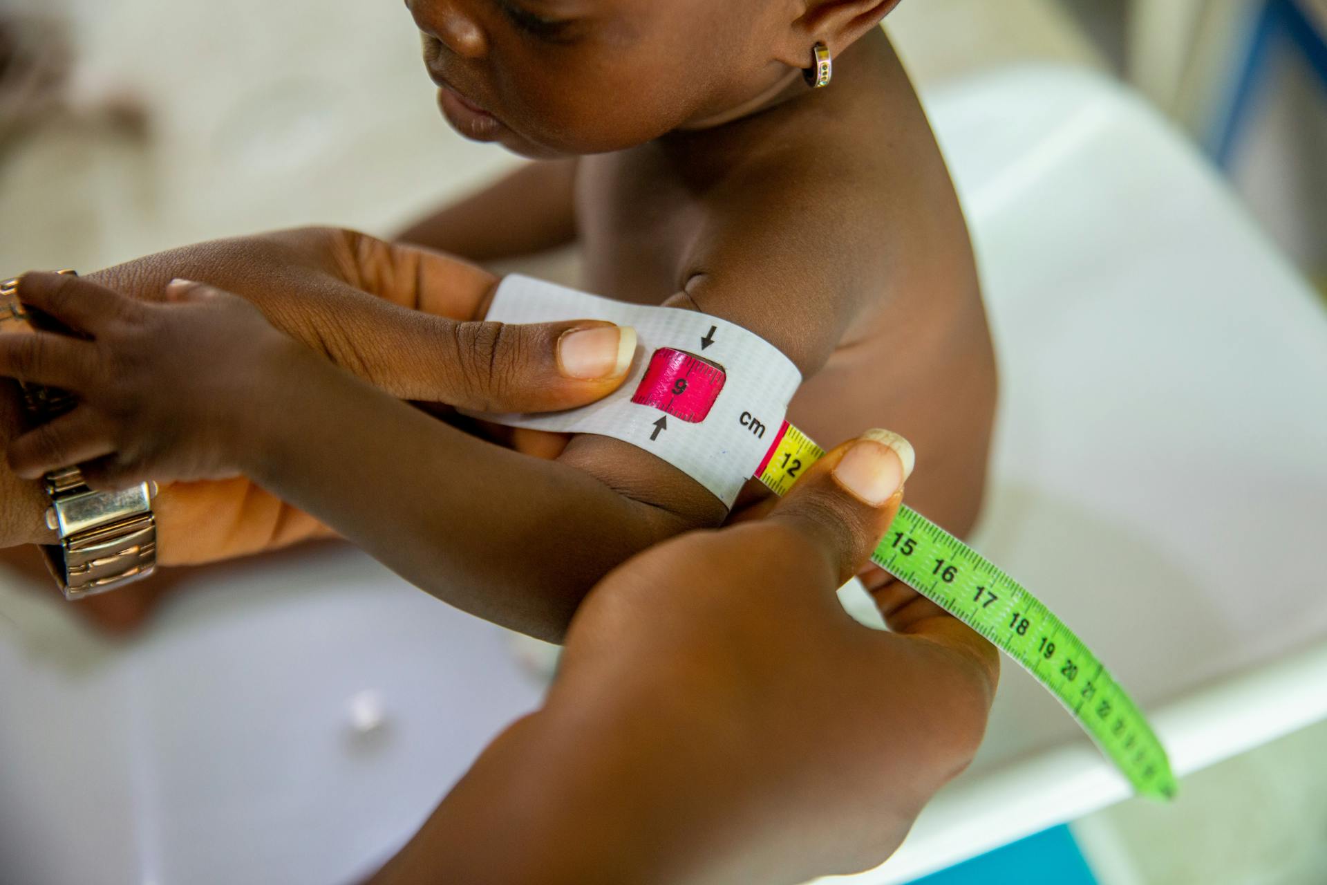 Protein Energy Malnutrition Protein Energy Malnutrition